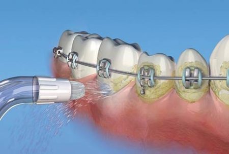 treatment of braces with an irritator